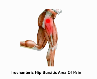 Do You Have Hip Pain? It Could Be Trochanteric Bursitis…
